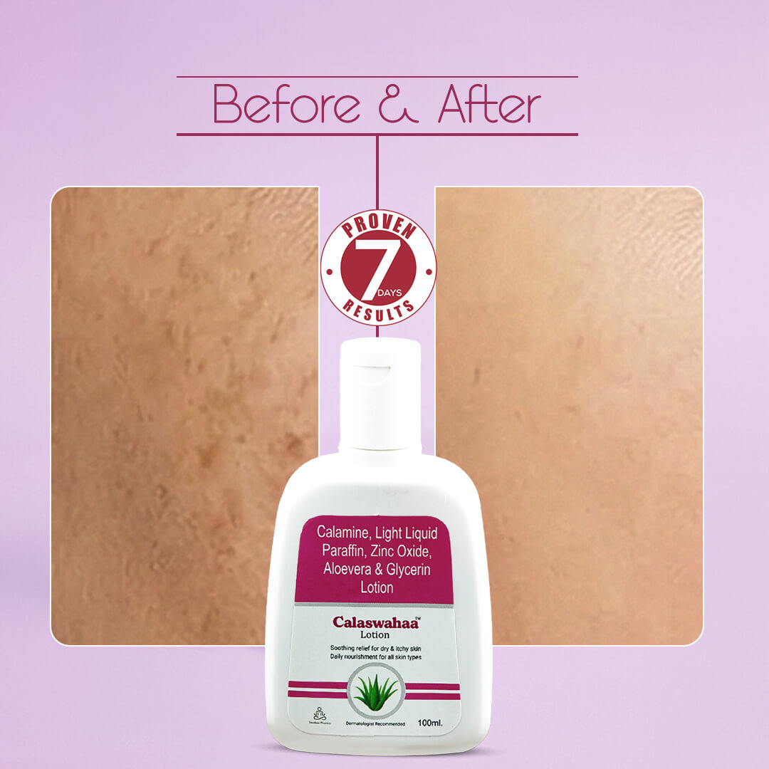 Calaswahaa Calamine Lotion