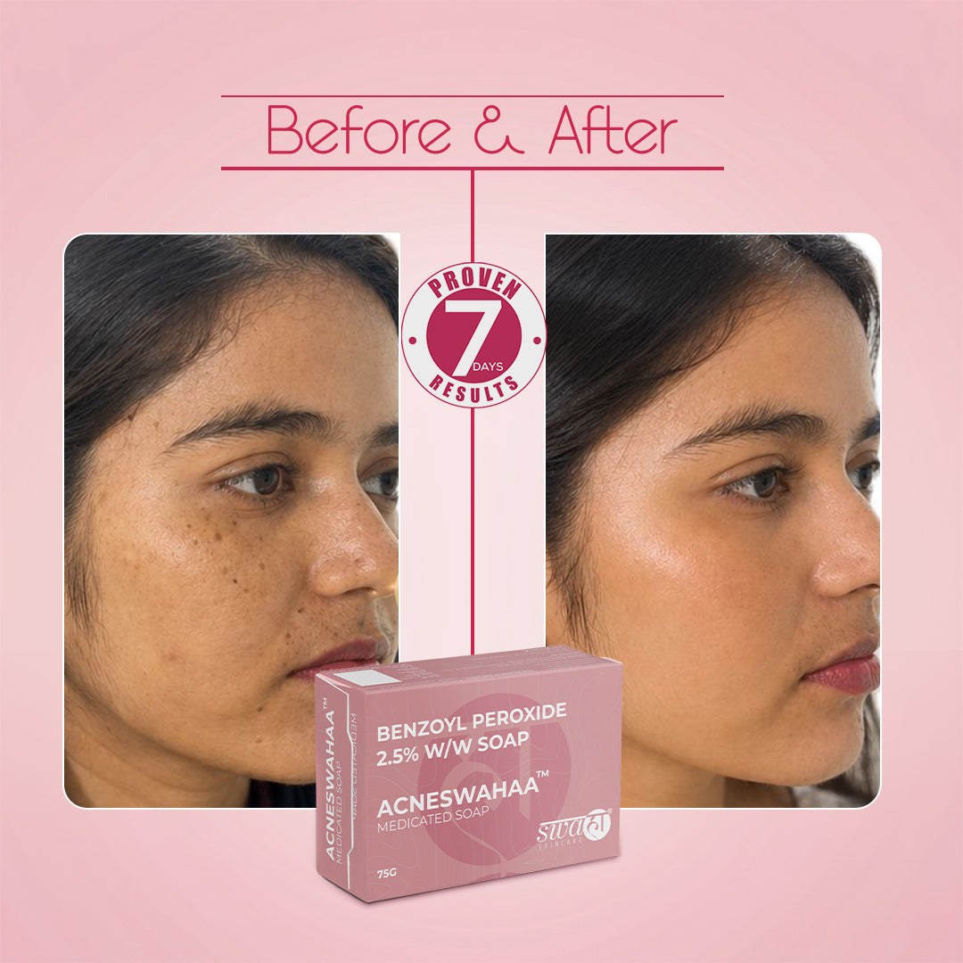 AcneSwahaa Medicated Soap | Pack of 3