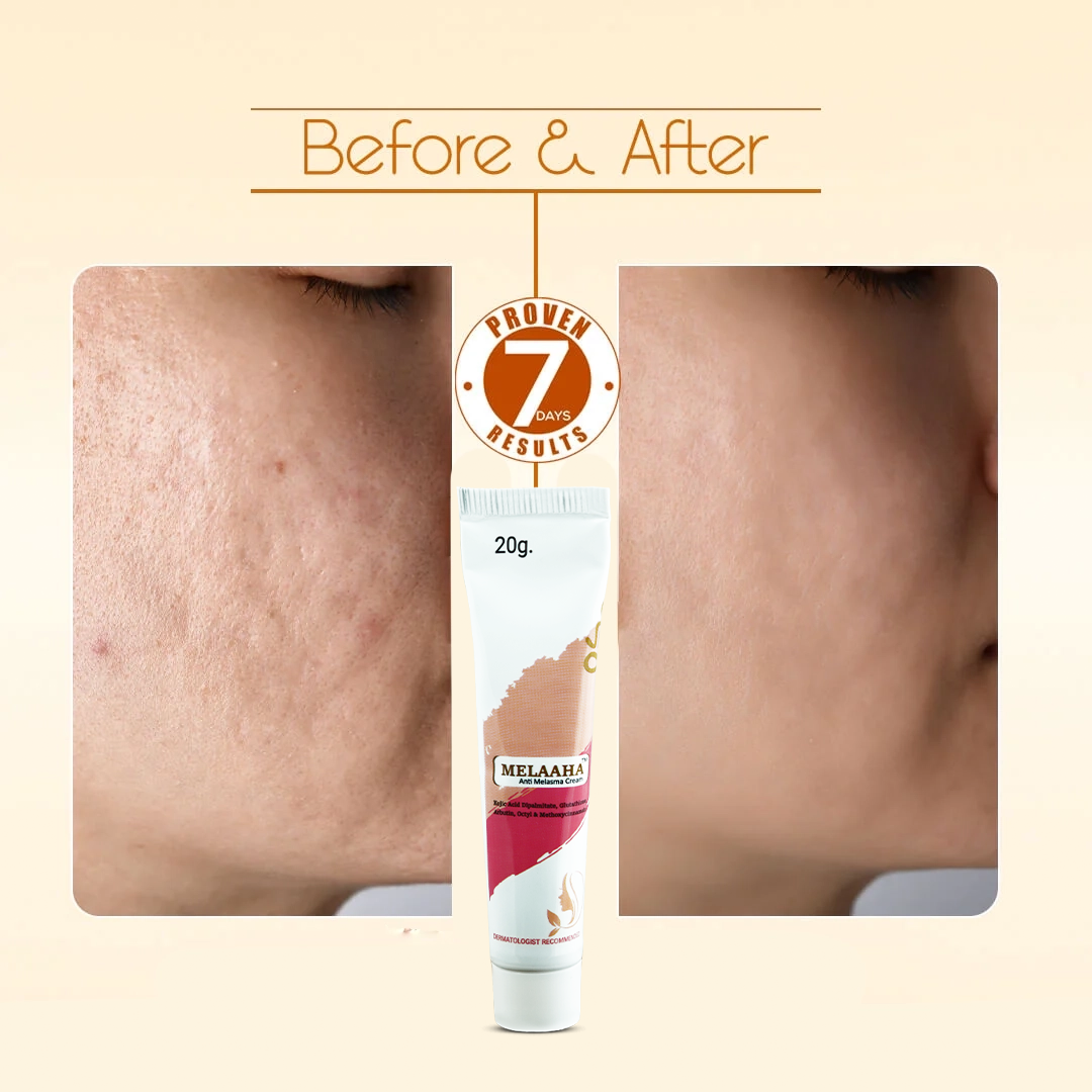 MELAAHA™ Anti Melasma Cream